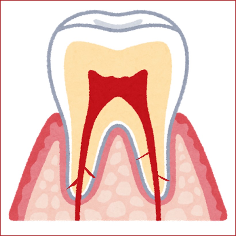 大臼歯までピッタリ根充を目指す国境の歯科医のクリニカル・エンドドン